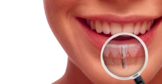 ¿Duelen los implantes dentales? (parte 1 de 2)