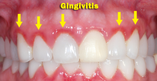 Gingivitis: prevenir, detectar y tratarla Parte 2