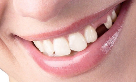 Reemplazar los dientes perdidos o ausentes: ¿Por qué es necesario?