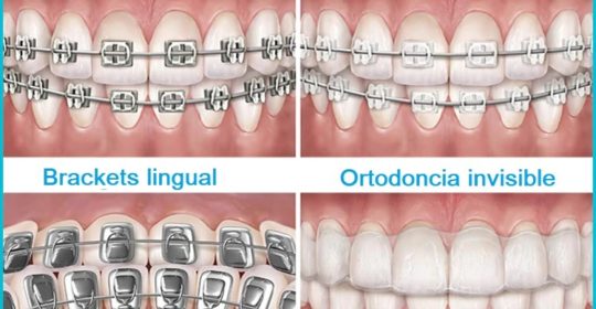 Tipos de ortodoncia: ¿Cuál es la mejor opción? Parte 2