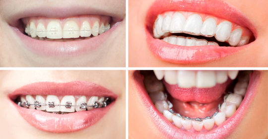Tipos de ortodoncia: ¿Cuál es la mejor opción? Parte 1